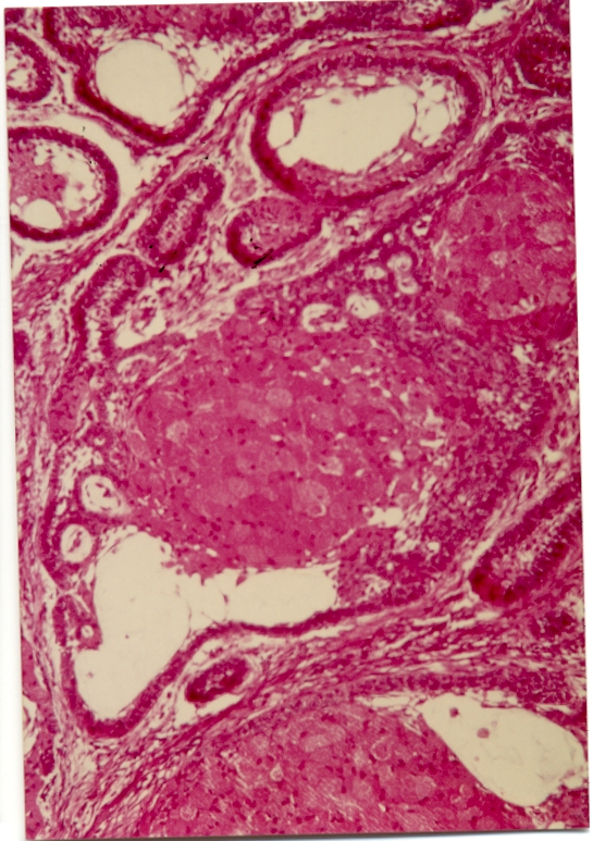 fok:targyak:oralpath_granular_cell_ameloblastoma.jpg