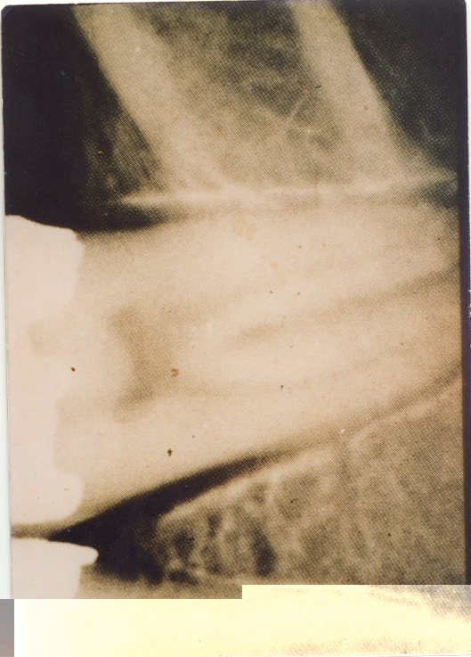 fok:targyak:oralpath_scleroderma_parodontium.jpg